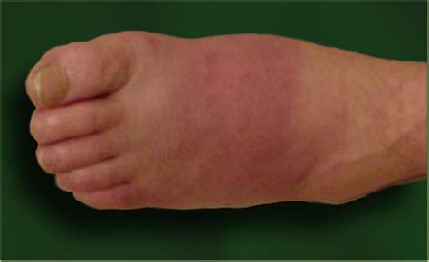 Charcot neuroarthropathy of the foot and ankle. - Post - Orthobullets