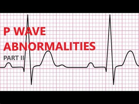 P Wave Abnormalities Part II - YouTube