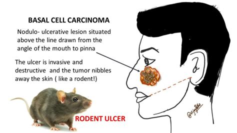 BASAL CELL CARCINOMA - Pathology Made Simple