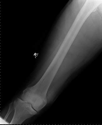 Radiology Cases: Fibrous Cortical Defect