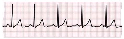 Electrocardiogram (ECG or EKG) | American Heart Association