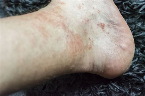 What causes a rash on my feet