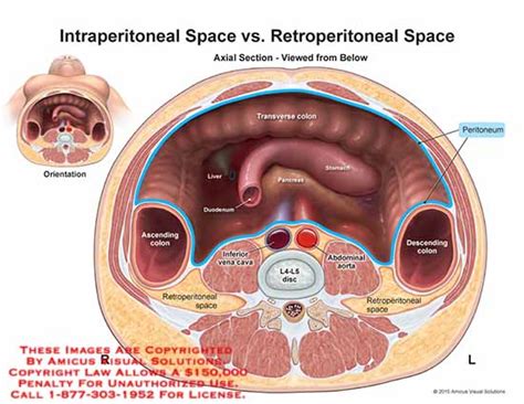 Intraperitoneal Space v. Retroperitoneal Space