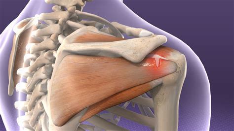 Rotator Cuff Injury - Laser Therapy in Newmarket