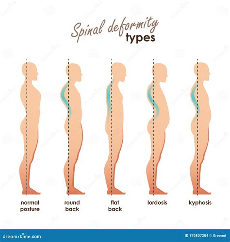 Spinal Deformity Types. Diseases of the Spine.Lordosis, Kyphosis, Round ...