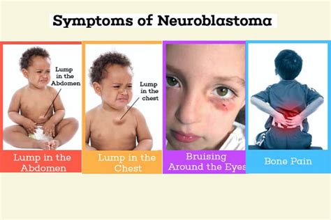 Neuroblastoma in Children: Stages, Symptoms, Causes, Treatment