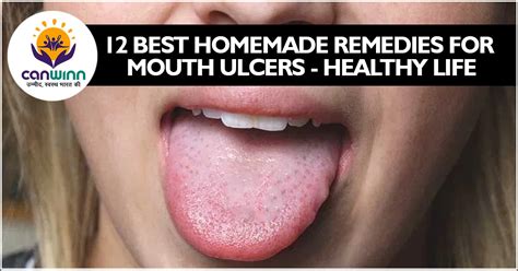 12 Best homemade remedies for mouth ulcers - Healthy Life - Canwinn