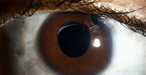 Aphakic Glaucoma