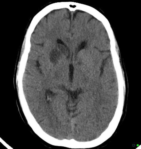 Corpus striatal infarct | Radiology Case | Radiopaedia.org | Radiology ...