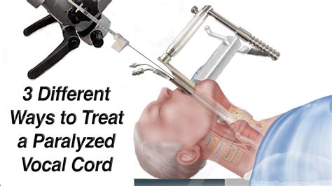 Different Methods Of Vocal Cord Paralysis Treatment Via, 40% OFF