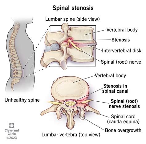 Spinal Stenosis: What It Is, Causes, Symptoms & Treatment