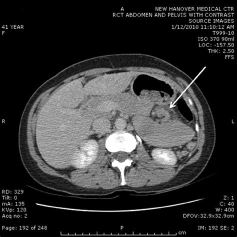 Axial view, CT scan of the abdomen. Note the nonanatomic position and ...