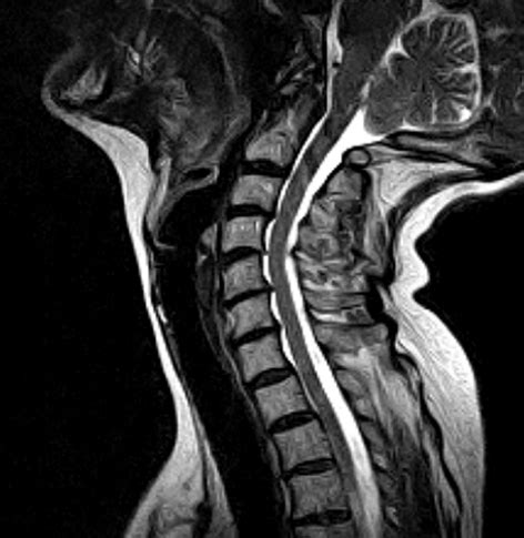 Cervical Spine MRI scan | Medserena Open MRI