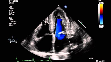 Rule out cardiac amyloidosis. 2D Echocardiogram w Doppler - YouTube