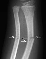 Greenstick Fracture - Definition, Causes and Treatment - (2018 - Updated)