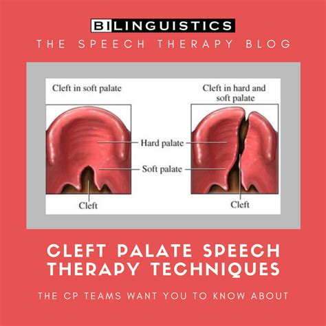 Cleft Palate Speech Therapy Techniques: CLP Team Tips | Cleft palate ...