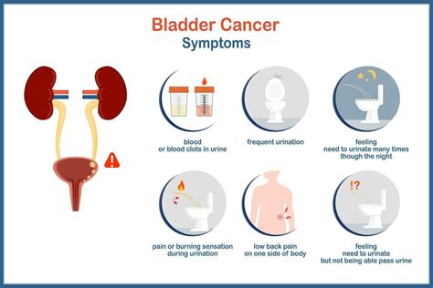 medical vector illustration infographic bladder cancer, bladder cancer ...