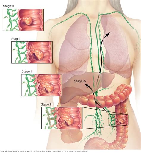 Colon cancer Disease Reference Guide - Drugs.com