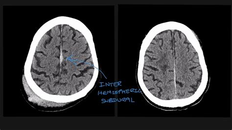 Understanding the different types of traumatic brain bleed on CT scans ...