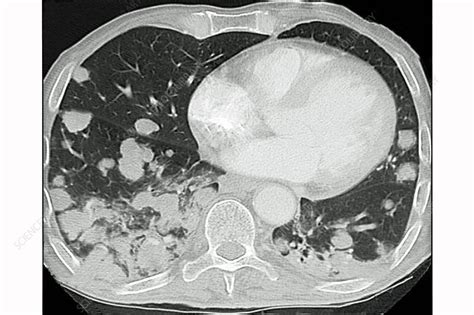 Lung Metastases, CT Scan - Stock Image - C030/6794 - Science Photo Library