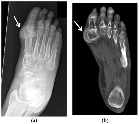 Gout Ankle Xray