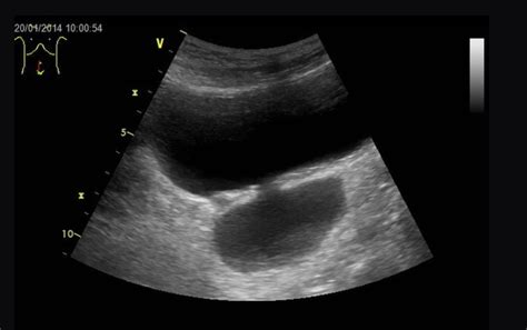 Bladder Diverticulum | Treatment & Management | Point of Care