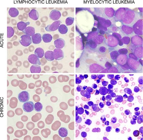 Sample microscopic images of Lymphocytic and Myelocytic Leukemia cells ...