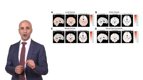 Research in 60 seconds: Metastasis & brain tumors