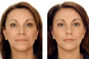 Wrinkle Fillers – Best Deep, Instant Injectable, Topical & OTC Face ...