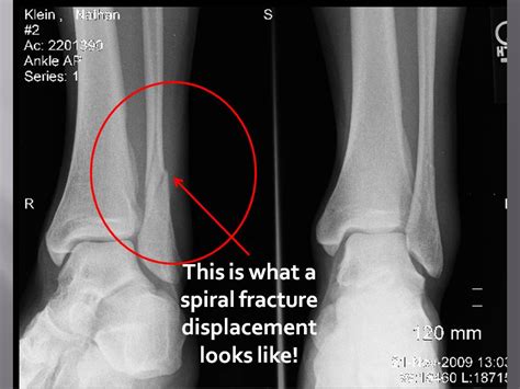 Fracture Of Fibula - Fracture Treatment