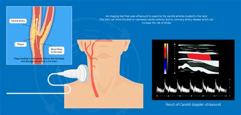 Carotid Arterial Duplex - Elite Cardiovascular Group