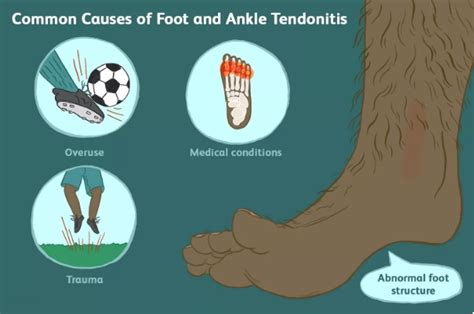 Ankle Arthritis/ Exostectomy Surgery – Dr George El Rassi