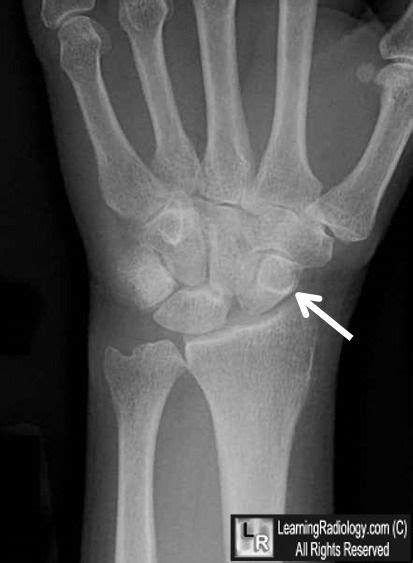 Scapholunate Dissociation | Radiology, Radiology schools, Medical