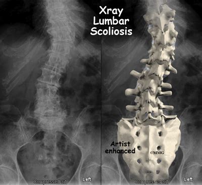 Adult Degenerative Scoliosis | eOrthopod.com