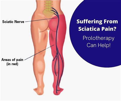 Get Rid of Sciatica Pain Without Surgery | The Prolotherapy Clinic