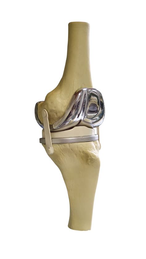 Knee Replacement Recovery: Guidelines, Tips, & Equipment | University ...