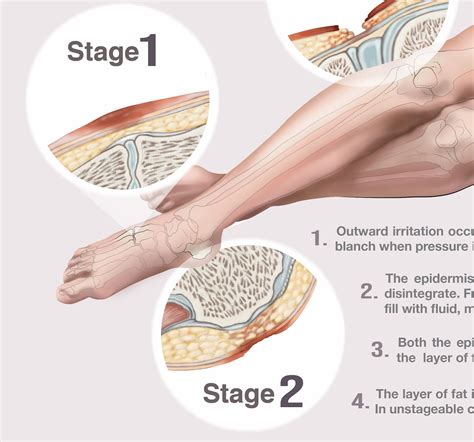 Bed Sore Stages: Patient Guide :: Behance