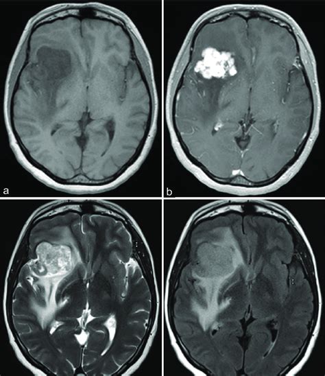 Brain Tumor Mri Without Contrast