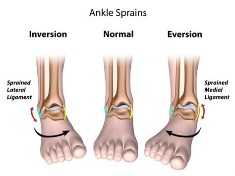 Ankle Sprain Treatment, Symptoms, and Prevention - Dr. Mikkel Jarman