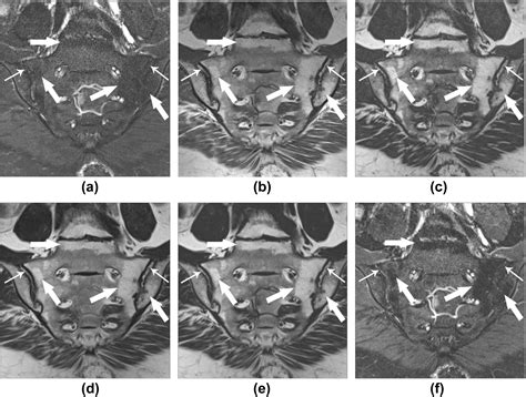 Qualitative and quantitative assessment of sacroiliitis in axial ...