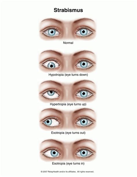 The Basics of a Strabismus Exam: