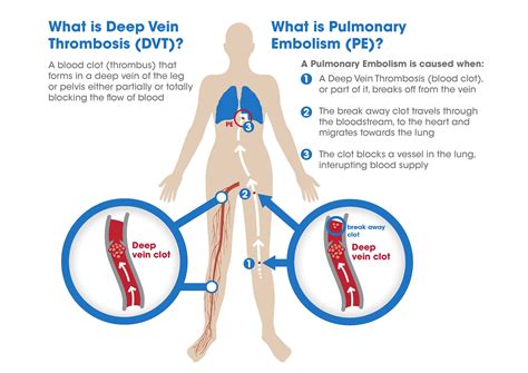 DVT/PE Treatment