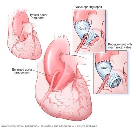 Aortic root surgery - Care at Mayo Clinic - Mayo Clinic