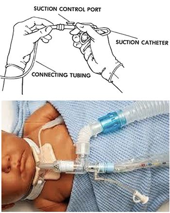 Tracheostomy Suction | Patient Education | UC Davis Children's Hospital