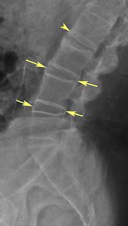 RiT radiology: Seronegative Spondyloarthropathy (SNSA)