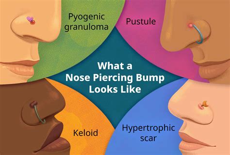 Nose Piercing Bump: How to Get Rid of It Fast