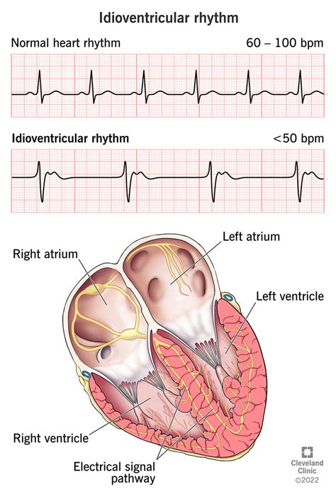 Accelerated Junctional Rhythm