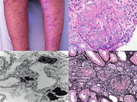 Patient's rash and kidney biopsy. Upper left: lower extremity rash ...