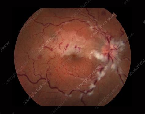 Purtscher's Retinopathy - Stock Image - C027/1480 - Science Photo Library