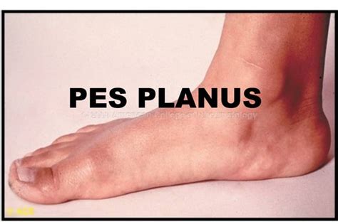 Pes Planus (Flat Foot): Causes, Symptoms, Diagnosis and Treatment | PPT